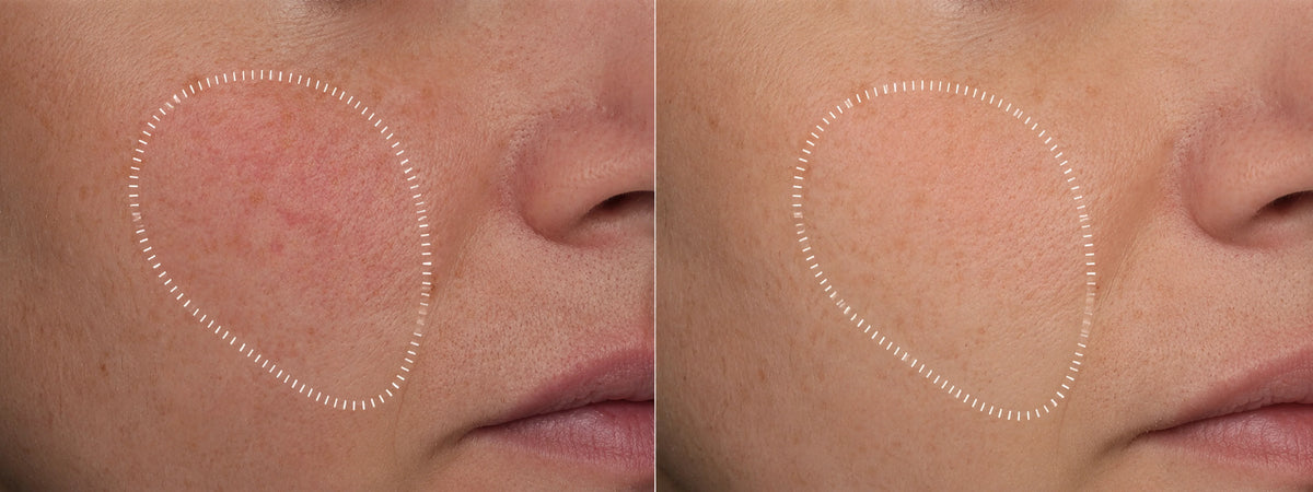 Before and after comparison showing reduced skin redness on a cheek using iokuro LIFT Jelly Peptide serum shots.