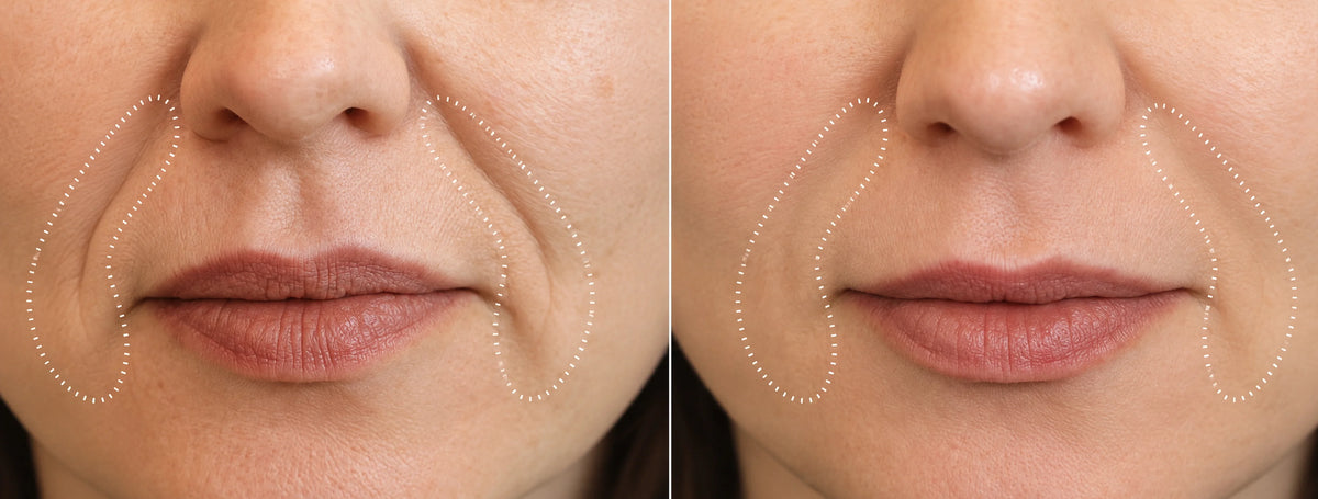Visible Results: Before & After Iokuro LIFT Treatment. Close-up comparison before and after applying the lifting face serum on nasolabial folds. The left side shows deep expression lines around the mouth highlighted with dotted lines, while the right side displays visibly plumper, smoother, and firmer skin.
